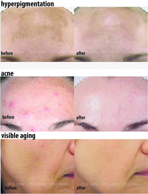 Chemical Peels Before and After Images