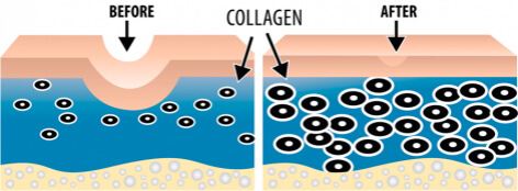 Collagen Before and After Micro Needling