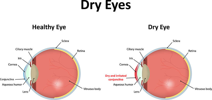 A Chart Showing a Healthy Eye Vs One With Dry Eye Syndrome