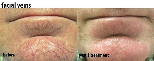 Facial Veings on Chin Before and After Images