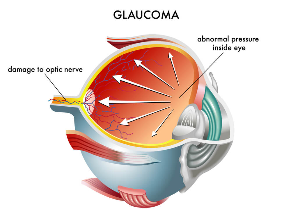 Glaucoma in the Eye