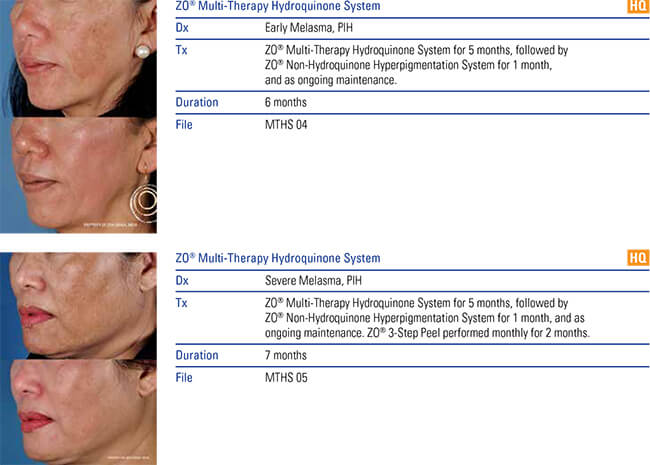 Hyperpigmentation procedure results