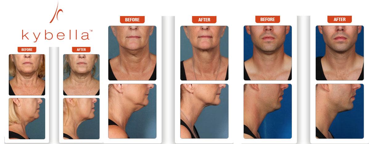 Kybella Before and After Images