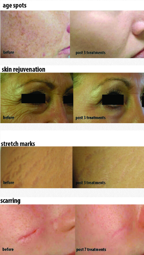 Photofacial Before and After Images