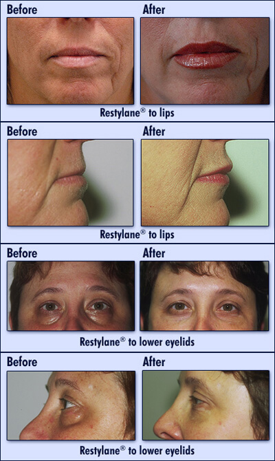 Restylane Before and After Images