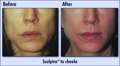 Sculptra Before and After Images