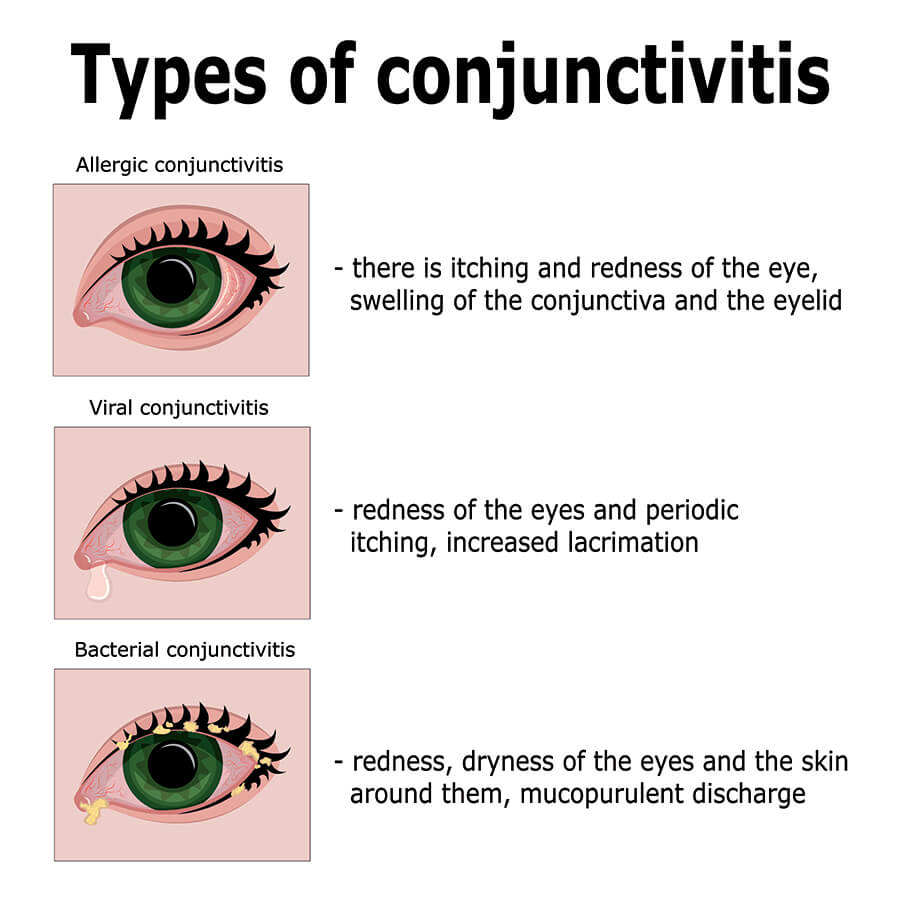 Chart Showing Types of Conjunctivitis