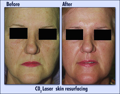 Before and After Laser Skin Resurfacing