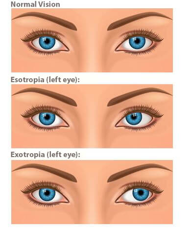 Chart showing an eye with normal vision, one with exotropia in the left eye, and one with exotropia in the left eye