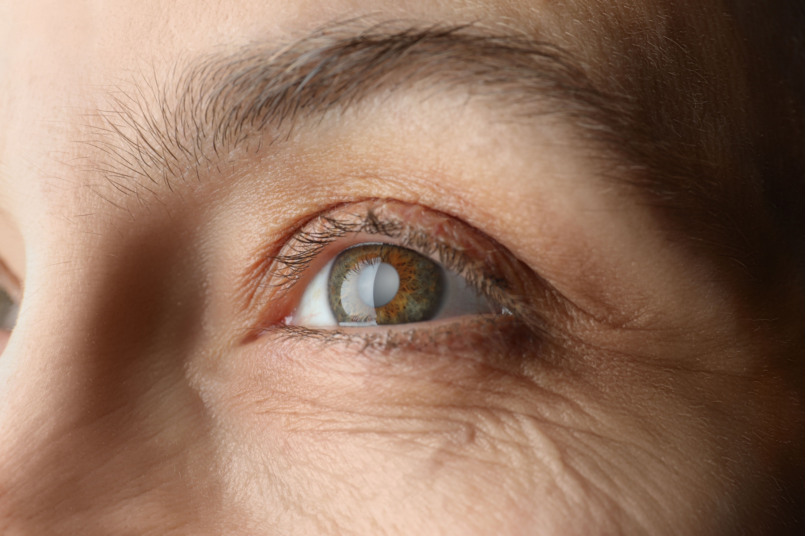 Cataracts 101: Myths vs. Facts